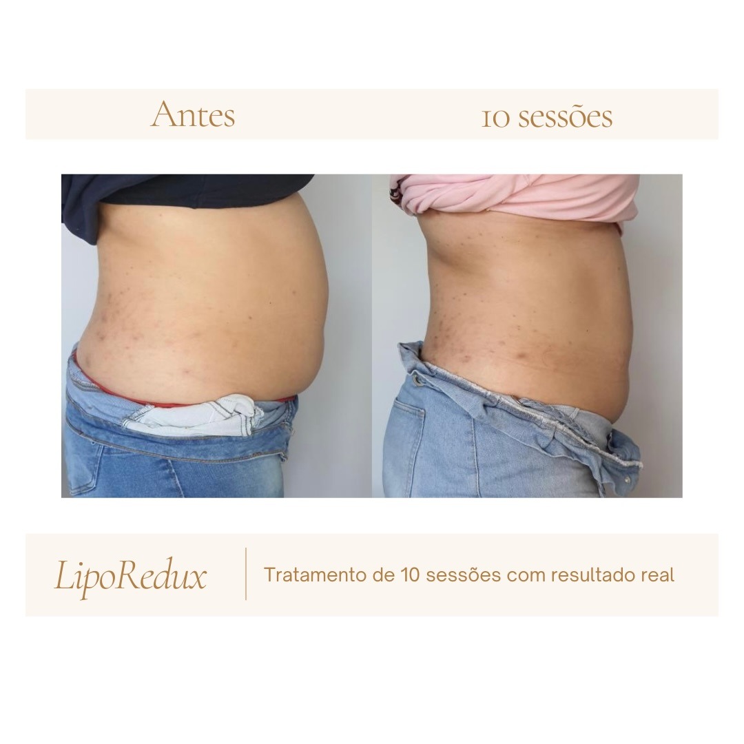 Antes e depois corporal após 10 sessões de LipoRedux