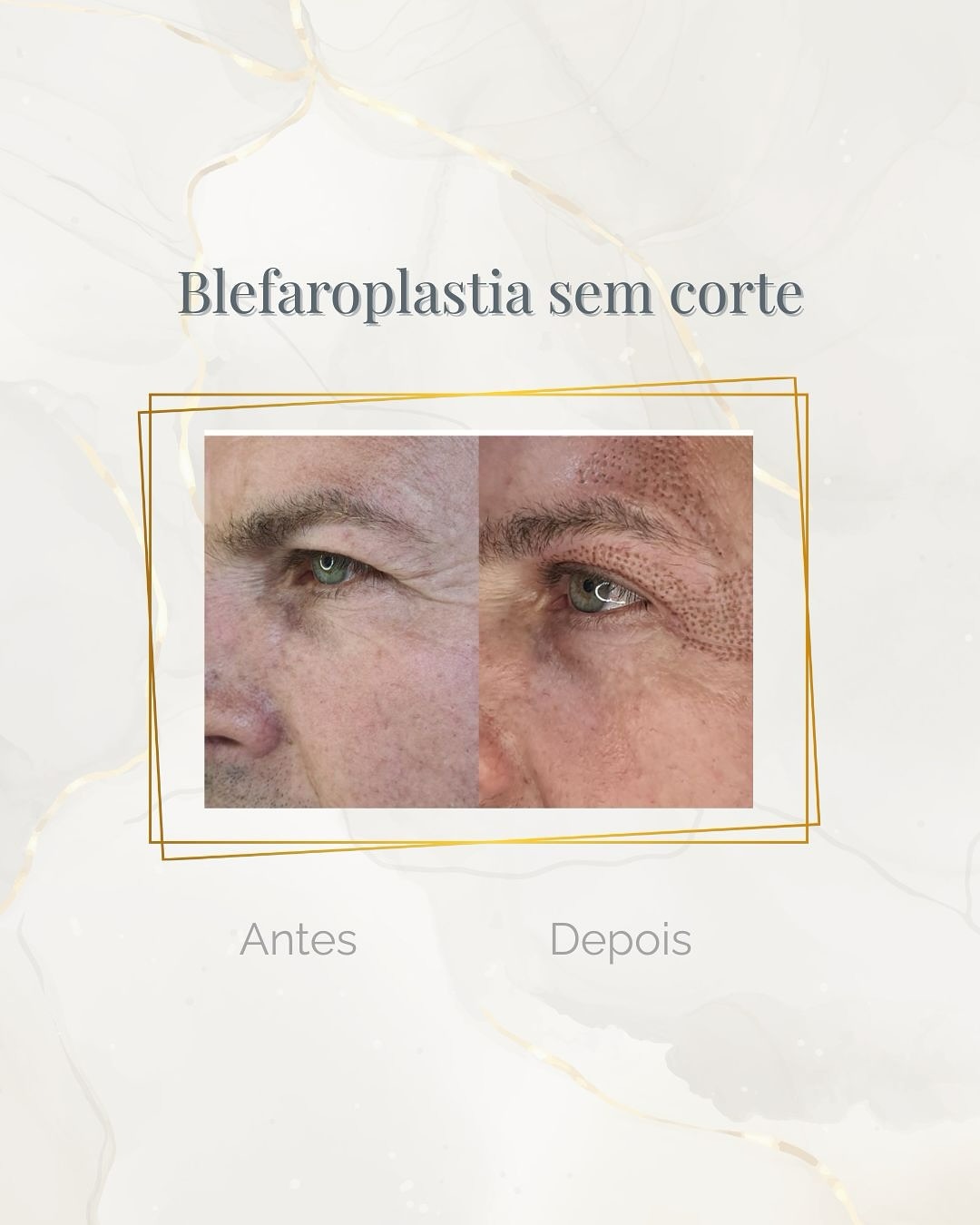 Antes e depois de blefaroplastia sem corte na região dos olhos